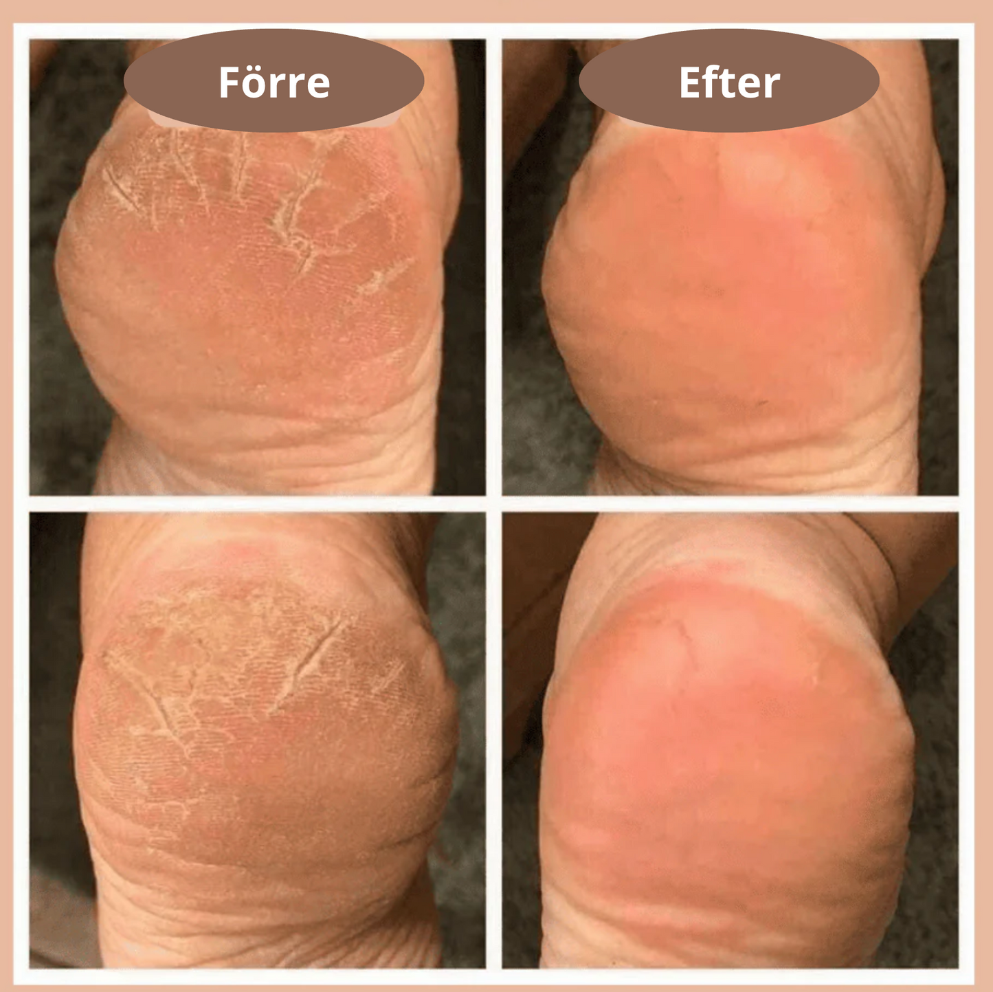 Säg Hejdå till Hälsmärta med CloudHeel™ – Din Lösning för Smärtsamma Fötter!