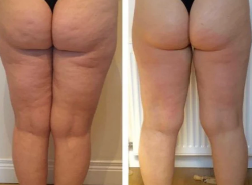 Velora™ Anti-Cellulite Oil Synligt slätare hud på 2–6 veckor