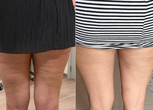 Velora™ Anti-Cellulite Oil Synligt slätare hud på 2–6 veckor