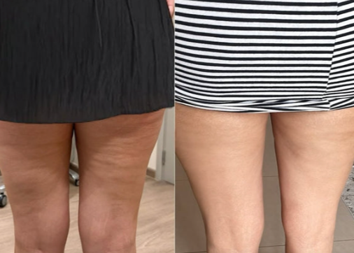 Velora™ Anti-Cellulite Oil Synligt slätare hud på 2–6 veckor