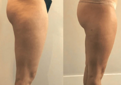Velora™ Anti-Cellulite Oil Synligt slätare hud på 2–6 veckor