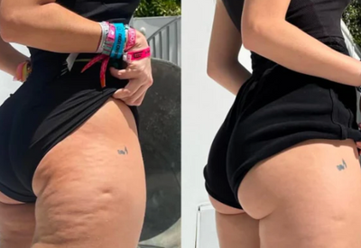 Velora™ Anti-Cellulite Oil Synligt slätare hud på 2–6 veckor