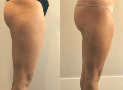 Velora™ Anti-Cellulite Oil Synligt slätare hud på 2–6 veckor