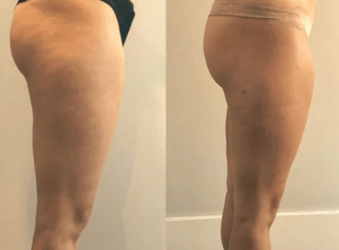 Velora™ Anti-Cellulite Oil Synligt slätare hud på 2–6 veckor